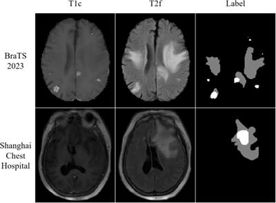 A novel metastatic tumor segmentation method with a new evaluation metric in clinic study